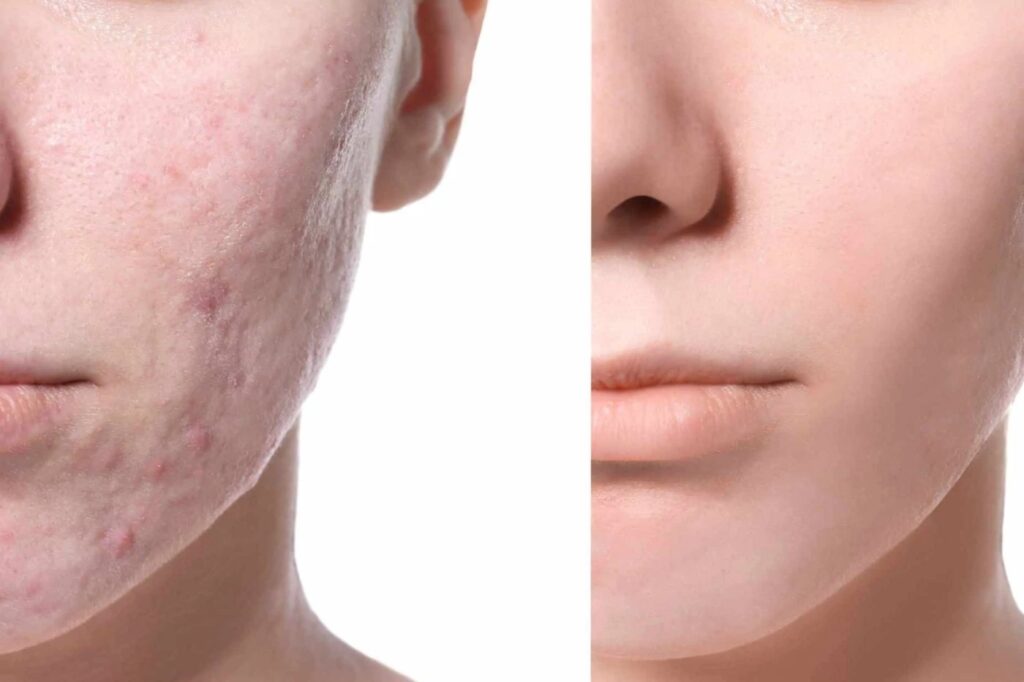 Skincare Untuk Kulit Kusam dan Berminyak